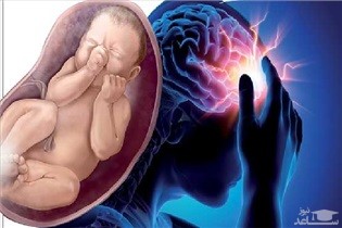 سردردهای طبیعی و غیر طبیعی در دوران بارداری