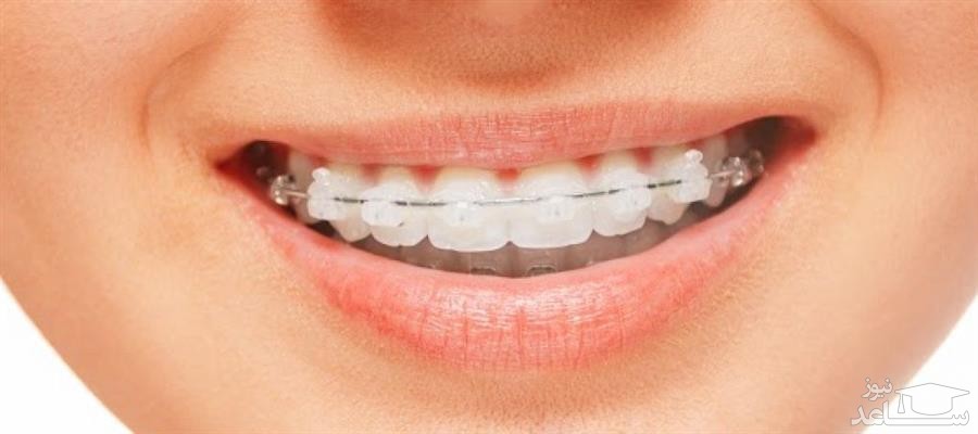 نحوه کشیدن نخ دندان برای بیماران ارتودنسی