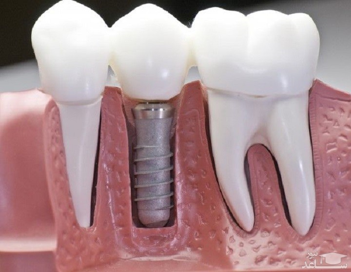 مراقبت های بعد از ایمپلنت دندان و عوامل موثر بر طول عمر آن