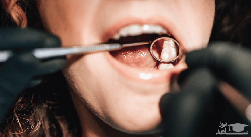 گزینه‌های درمانی برای دندان ترک خورده چیست؟
