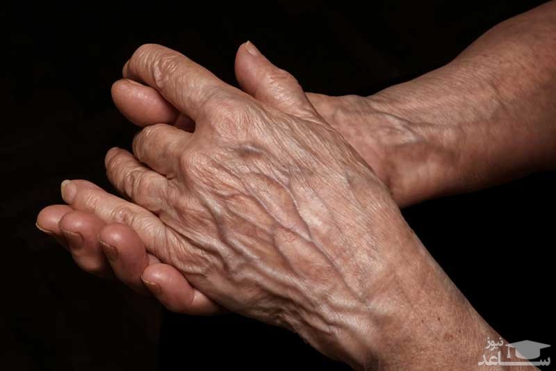 درمان خانگی لکه های پیری روی دست