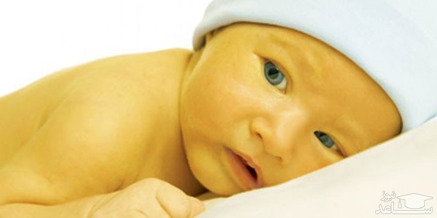روش های درمان زردی نوزاد با طب سنتی