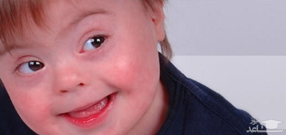 تولد کودک مبتلا به سندروم دان در کدام زوج ها بیشتر دیده میشود؟