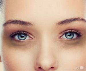 علل کبودی و سیاهی دور چشم و درمان آن