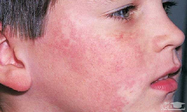 علائم بیماری مخملک در کودکان و راههای درمان