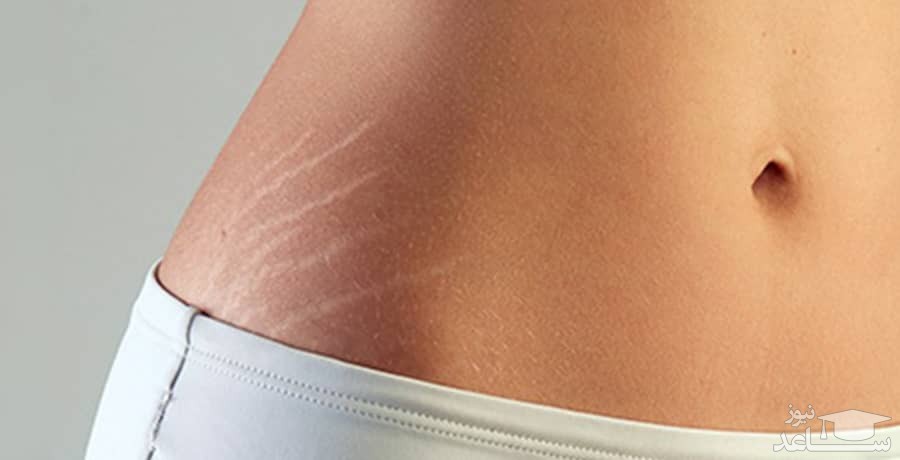 روش هایی برای درمان ترک های پوستی