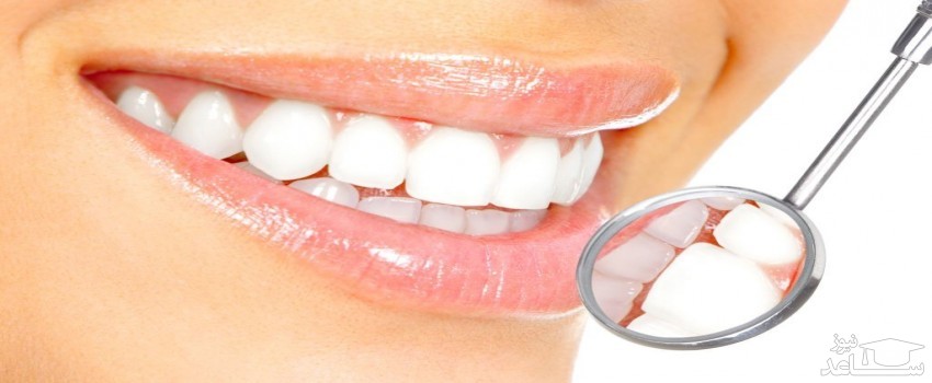 همه چیز درباه ی لمینت دندان