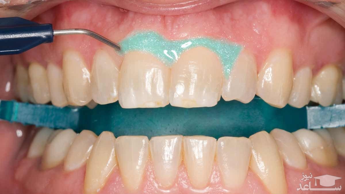 مراحل جرمگیری دندان چیست؟