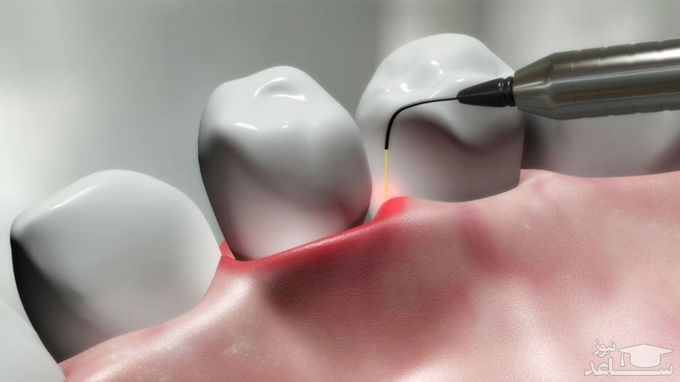 همه چیز در مورد استفاده از لیزر در ایمپلنت دندان