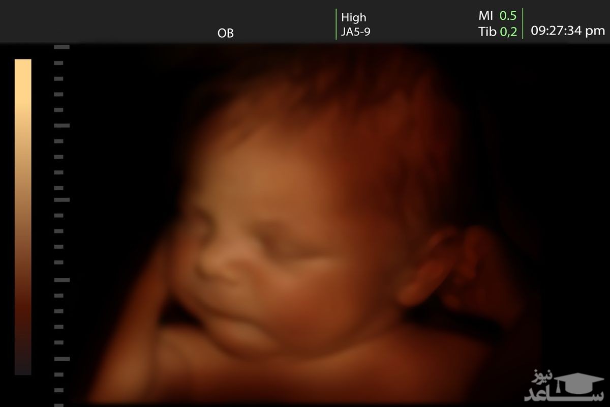 همه چیز درباره سونوگرافی سه بعدی در دوران بارداری