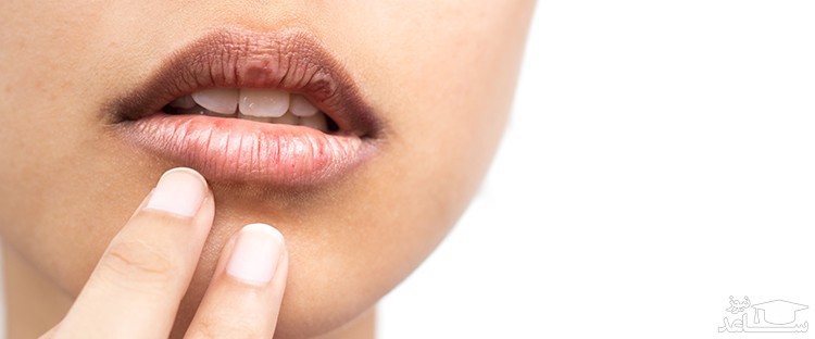 علت مزه فلز دهان در افراد مختلف چیست؟