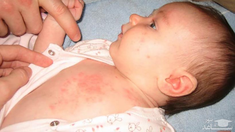  عرق سوز شدن یا راش گرمایی چیست؟