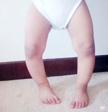 علل پای پرانتزی در کودک و راههای درمان قطعی