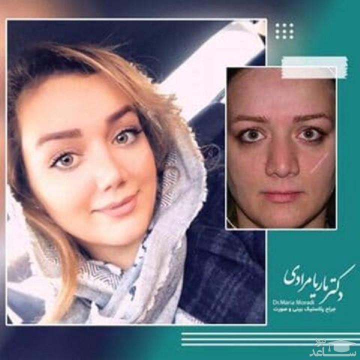 عمل بینی با جدیدترین روش با دکتر ماریا مرادی