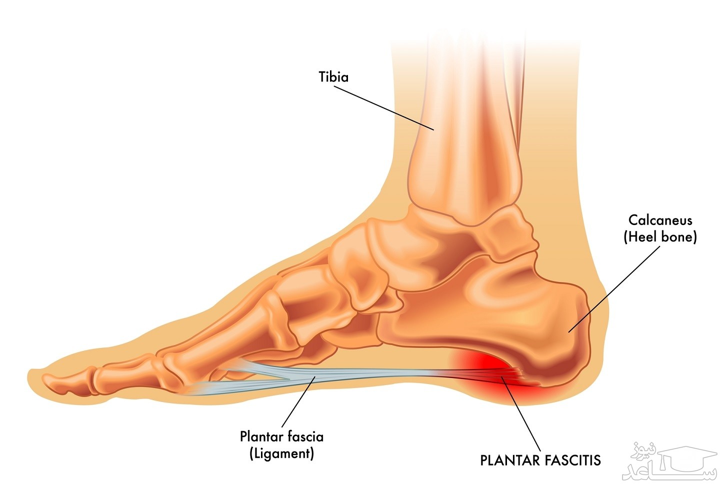 در مورد التهاب فاسیای کف پا چه می دانید؟