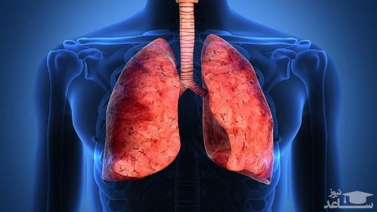 تصویر ترسناک از ریه یک بیمار شدید کرونایی