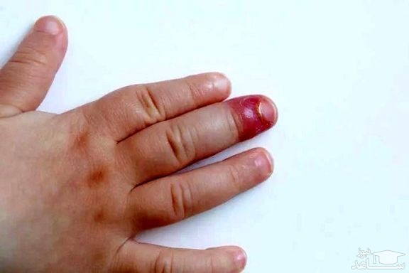 علل عقربک ناخن و راههای درمان آن