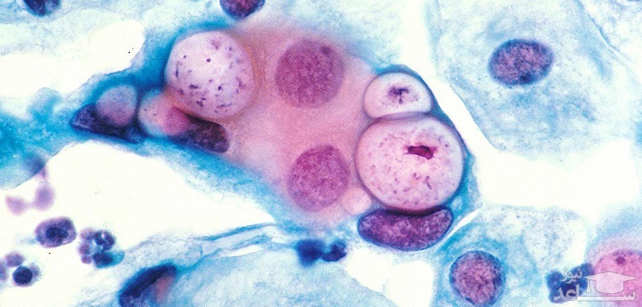 تاثیر ترشحات عفونی بر سلامت جنین