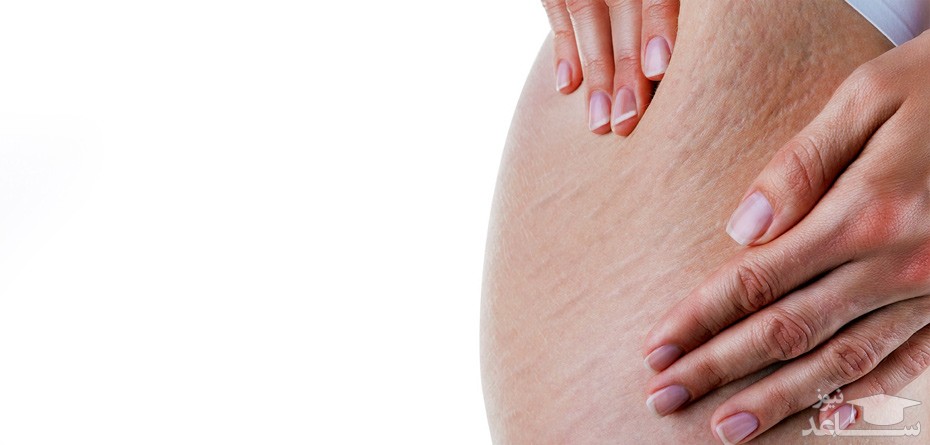 درمان ترک های پوستی در دوران بارداری