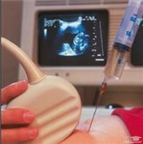 علت انجام تست آمینوسنتز در بارداری