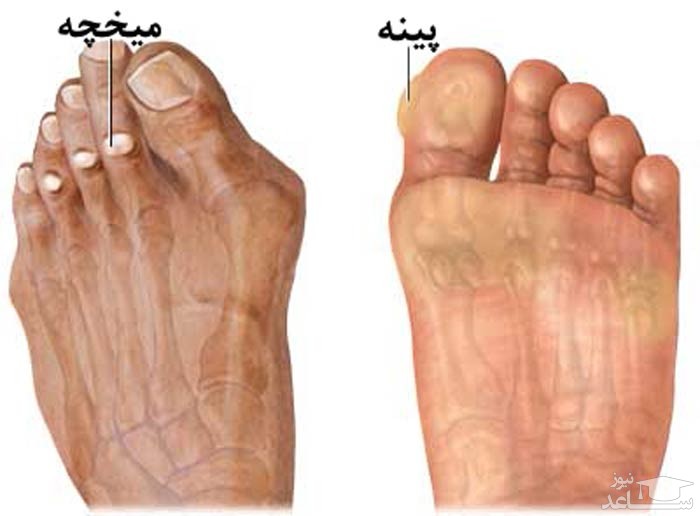  میخچه و پینه