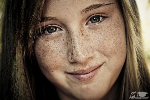 کک و مک صورت و درمان آن