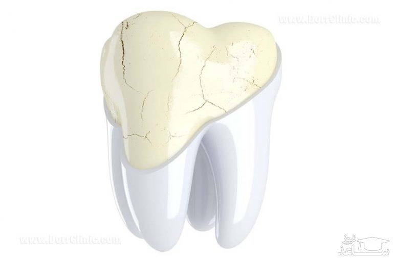 دندان سایش یافته چیست و انواع آن؟