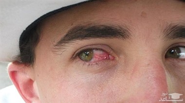 علل ناخنک چشم و راههای درمان آن