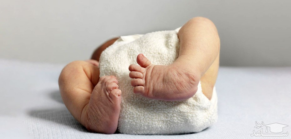 دلایل چنبری شدن پاهای نوزاد و روش های درمان
