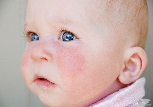 خطرات اشعه مضر آفتاب در بچه ها