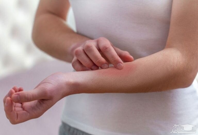 دلایل حساسیت پوست به طلا و روش های درمان