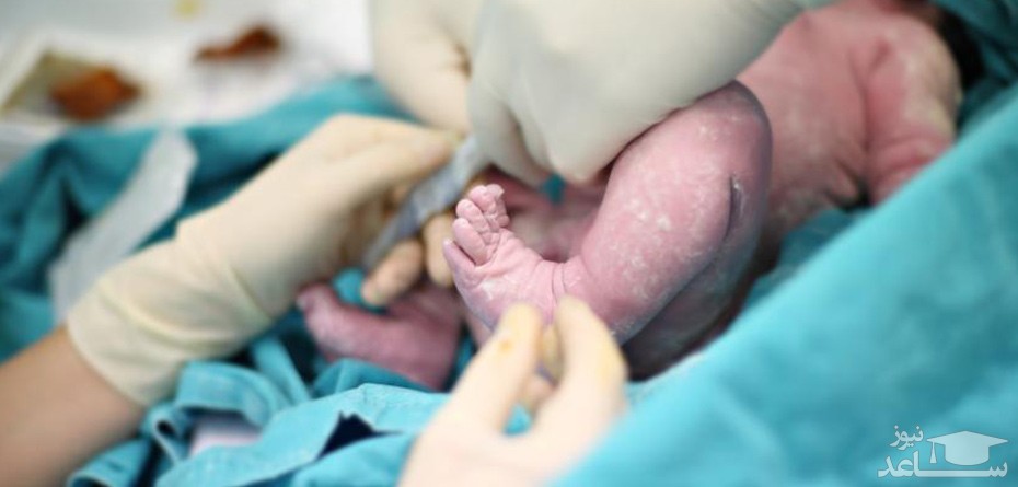 تاثیر قد مادر باردار بر سهولت زایمان