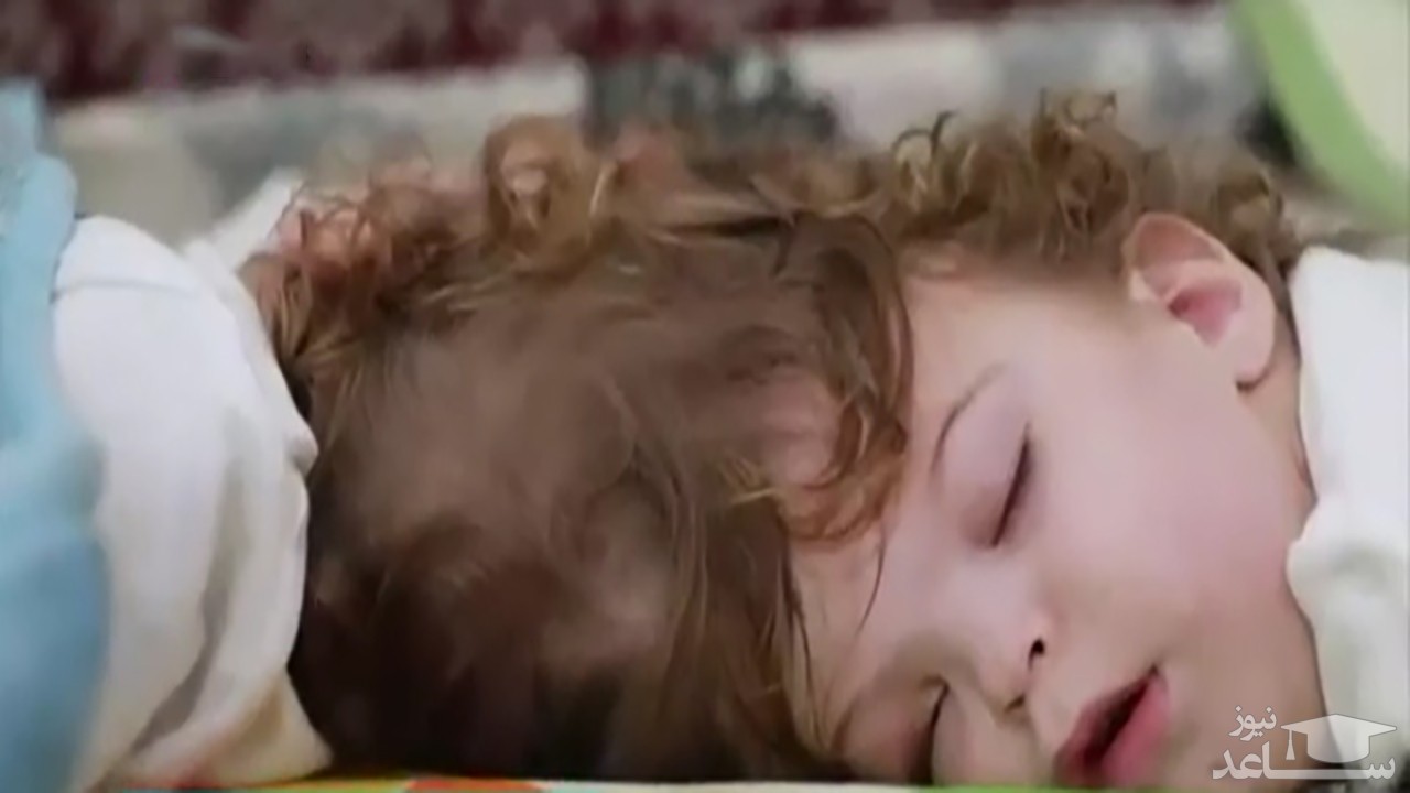 (فیلم) جداسازی دوقلوهای به هم چسبیده از ناحیه جمجمه