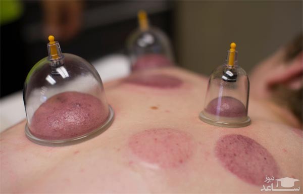 انواع حجامت و درمان بیماری ها