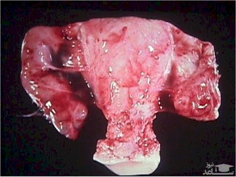 علل التهاب لگن در زنان و راههای درمان آن