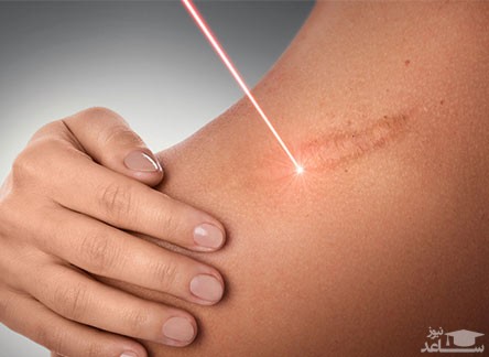 لیزر کلوئید