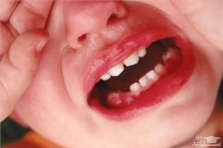 اقدامات موثر هنگام شکستگی دندان کودک