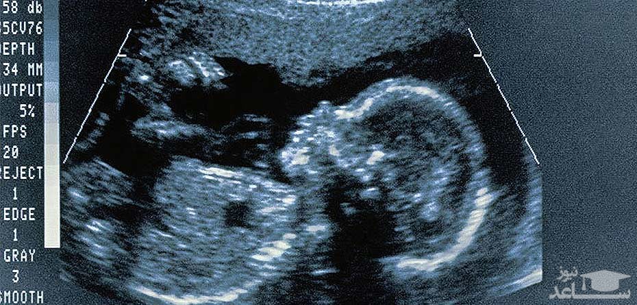 تشخیص ناهنجاری های دستگاه  ادراری در جنین