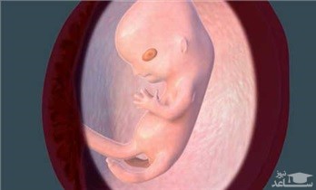 دلایل افزایش بیش از حد مایع آمنیوتیک در بارداری