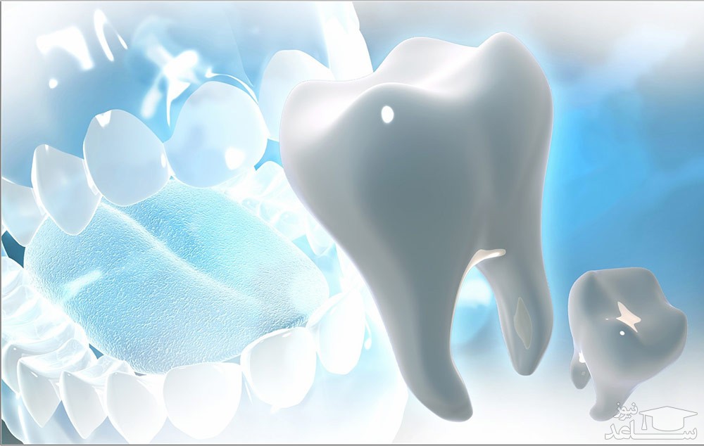 3 مورد از معایب مهم کامپوزیت ونیر دندان