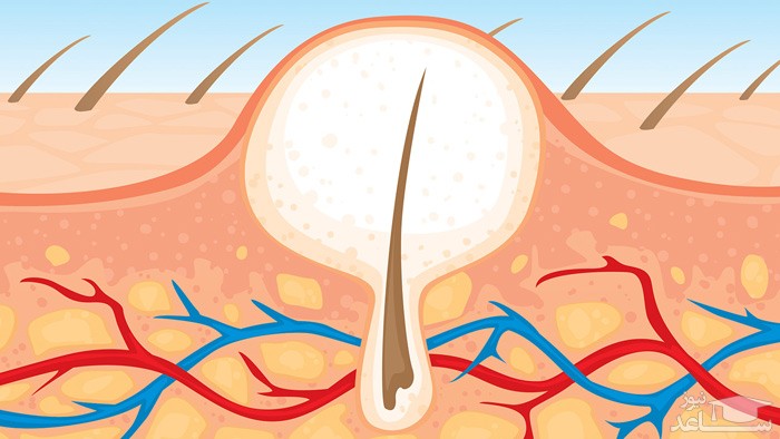علت ایجاد موهای زیر پوستی چیست؟