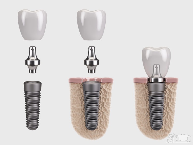 معرفی ایمپلنت های دندانی گوناگون
