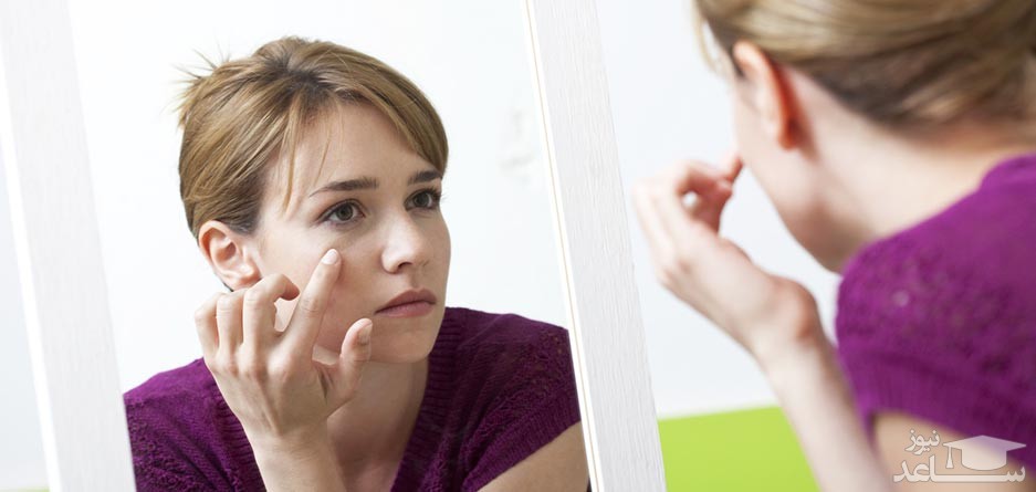 علت پف کردن چشم در دوران بارداری و روش های درمان