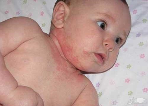 علل عرق سوز شدن و راههای درمان آن