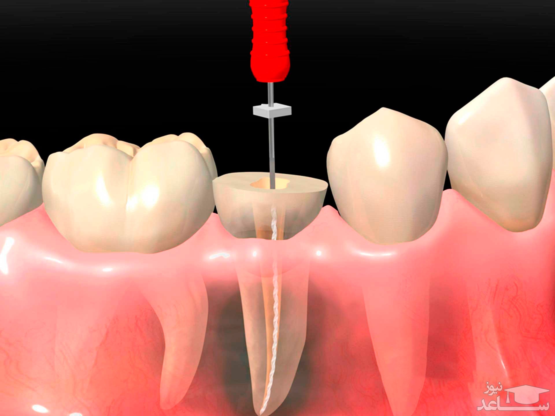 ریشه درمانی دندان
