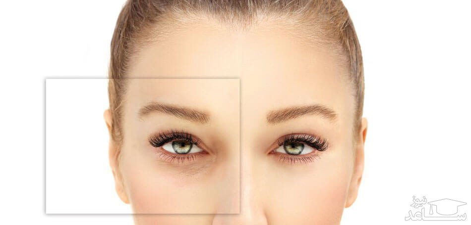 کربوکسی تراپی چیست؟