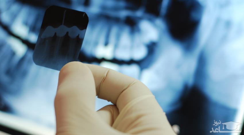 رادیوگرافی تک دندان ( پری اپیکال ) چیست؟