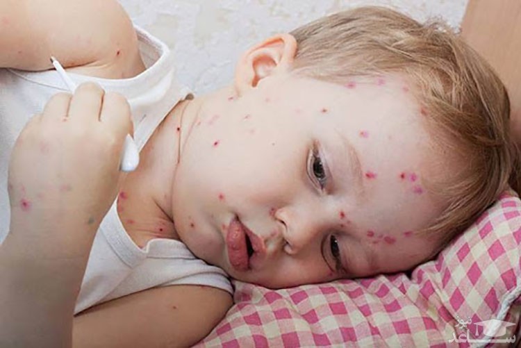 9 بیماری پوستی شایع در کودکان