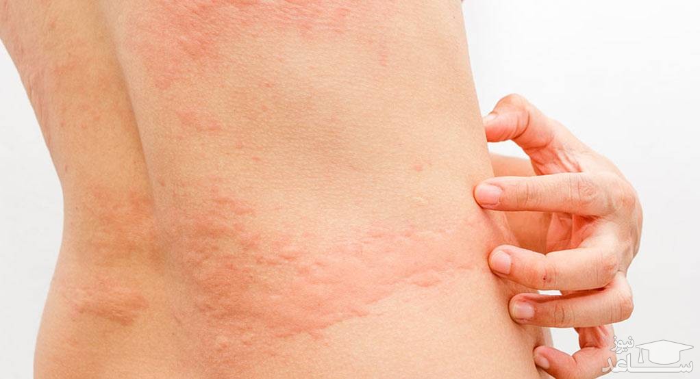 سوالات متداول در مورد کهیر پوستی در بارداری