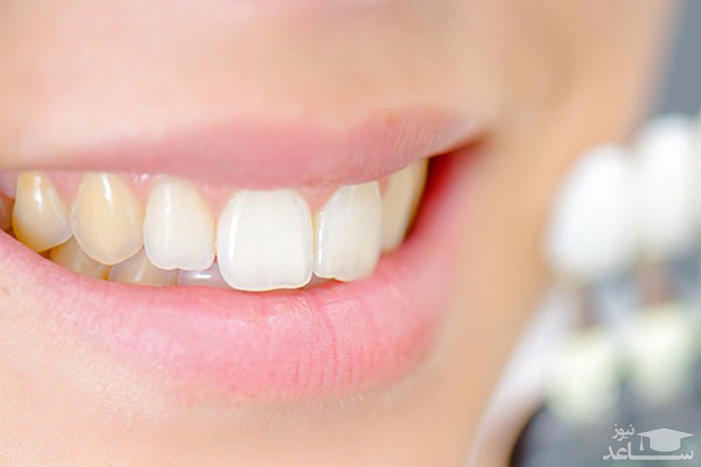 آیا راهی برای پیشگیری از فرسایش مینای دندان وجود دارد؟